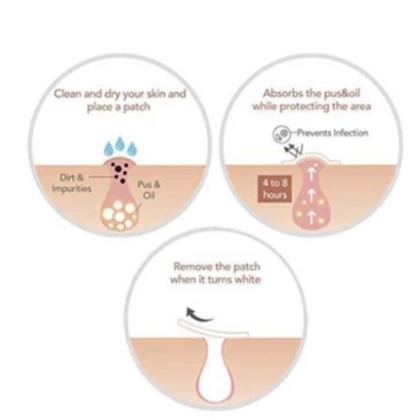 Acne Skin Spot Patches
