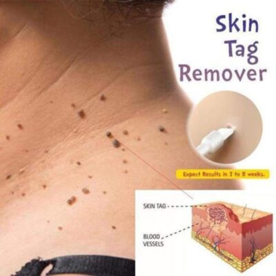 Skin tag remover